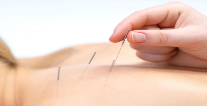 acupuntura CADE